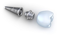 Dental Implants | grand Rapid, MI | Burton Dental Associates