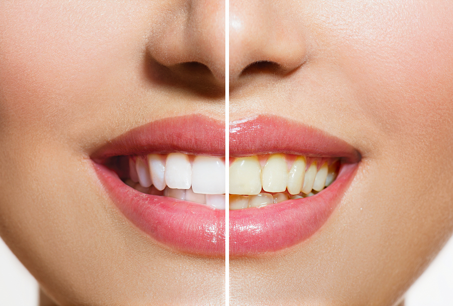 Teeth Whitening | Dentist In Grand Rapids, MI | Burton Dental Associates